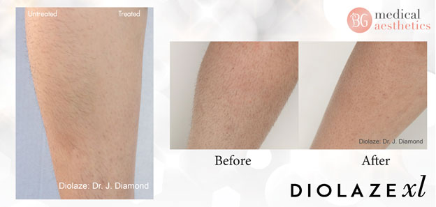 Clinical Diode Laser Hair Removal Technology – Diolazexl - Key