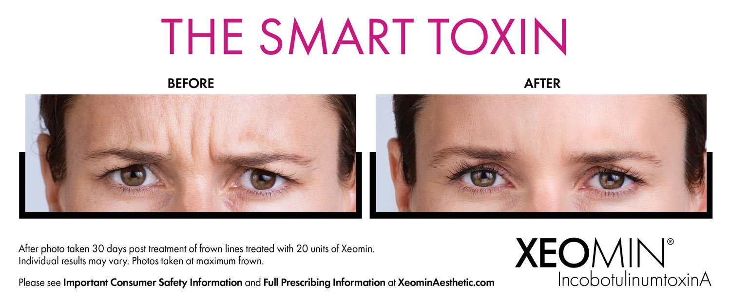 Xeomin Graphics What Is Xeomin? | Anti-Aging Solution | BG Medical Aesthetics